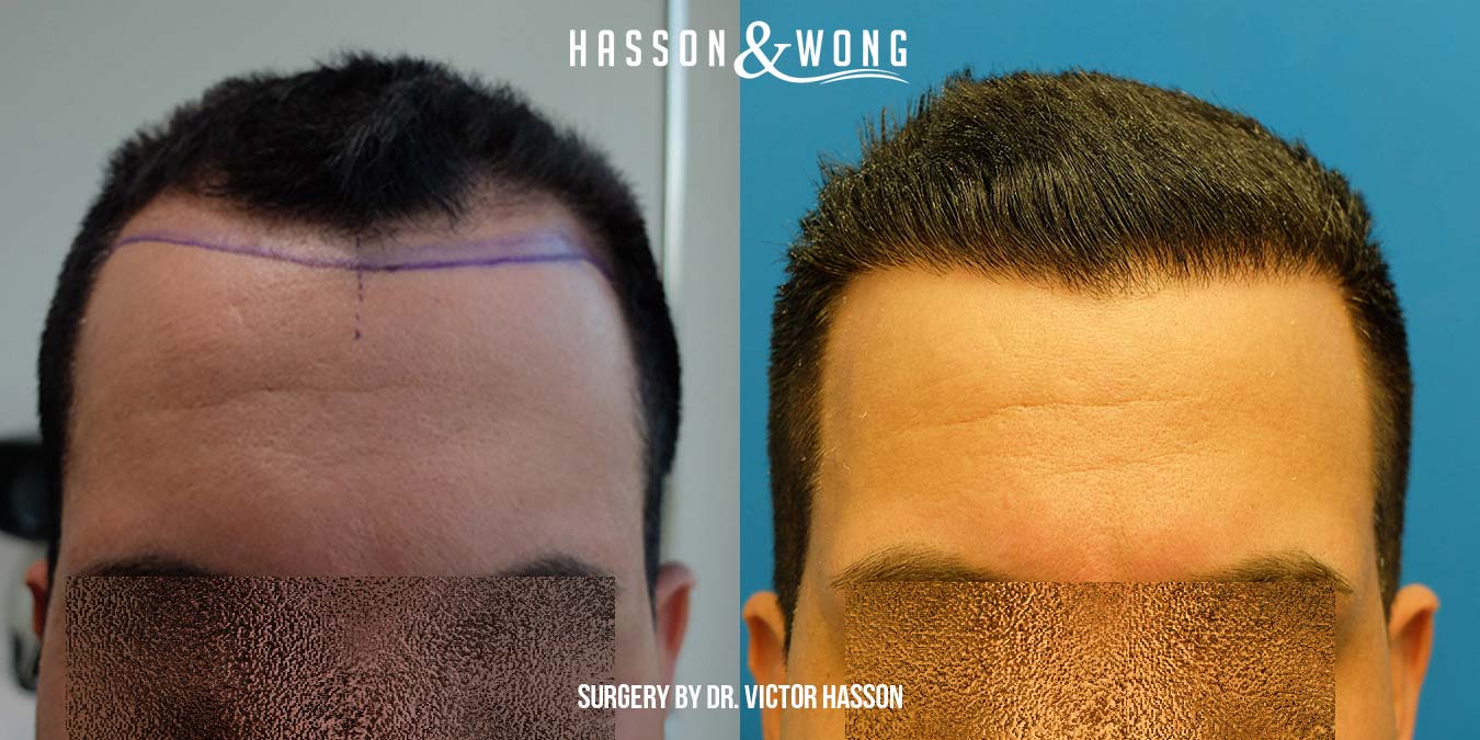 Dr. Hasson 3666 Grafts/FUT/ Hairline Reconstruction/ 1 Year Post Op.